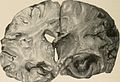 Nervous and mental diseases (1911) (14798066953).jpg