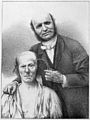 Duchenne de Boulogne, faradising the frontal muscles Wellcome M0011346.jpg