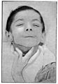 A.F. Tredgold, Mental Deficiency (Amentia) Wellcome L0030471.jpg