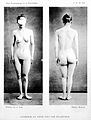 Asymetrie du corps chez une epileptique' Wellcome L0020549.jpg
