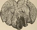 Nervous and mental diseases (1911) (14777847222).jpg