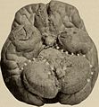 Nervous and mental diseases (1919) (14781365112).jpg